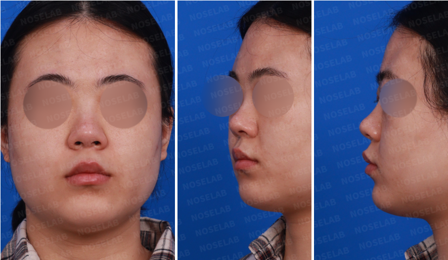 Frontal, left profile, and oblique preoperative views of a patient undergoing straight-line nose surgery using rib cartilage.