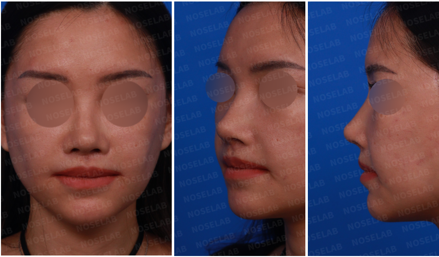 Design consultation photos before customized rhinoplasty with specific requests – frontal, left oblique, and side views showing columella position, nostril asymmetry, and nasal tip shape.