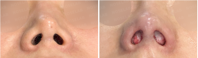 Nostril view before and immediately after closed rhinoplasty Korea — showing improved nostril symmetry and reduced flare using rib cartilage reconstruction.