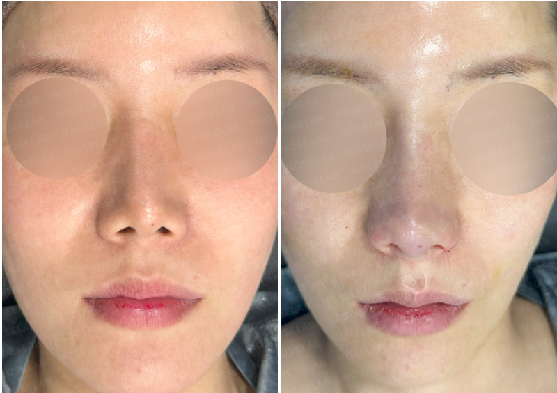 Frontal comparison before and immediately after closed rhinoplasty Korea using rib cartilage — showing tip refinement and dorsal correction.