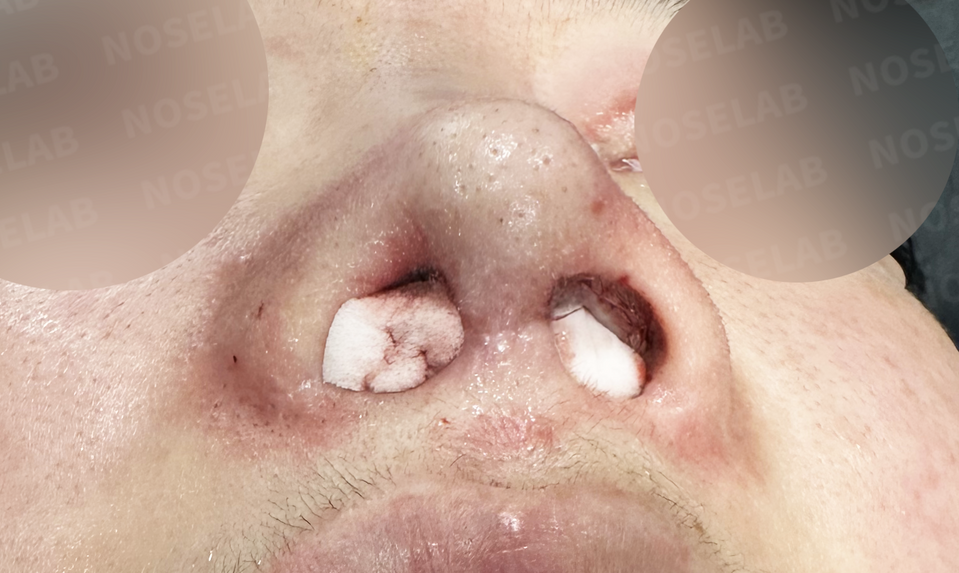 Immediately after surgery: nostril view.