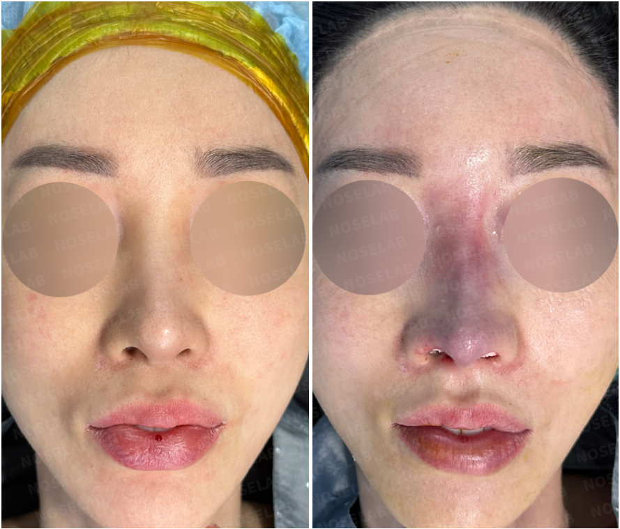 Frontal before and after long nose correction, showing improved symmetry and less blunt appearance.