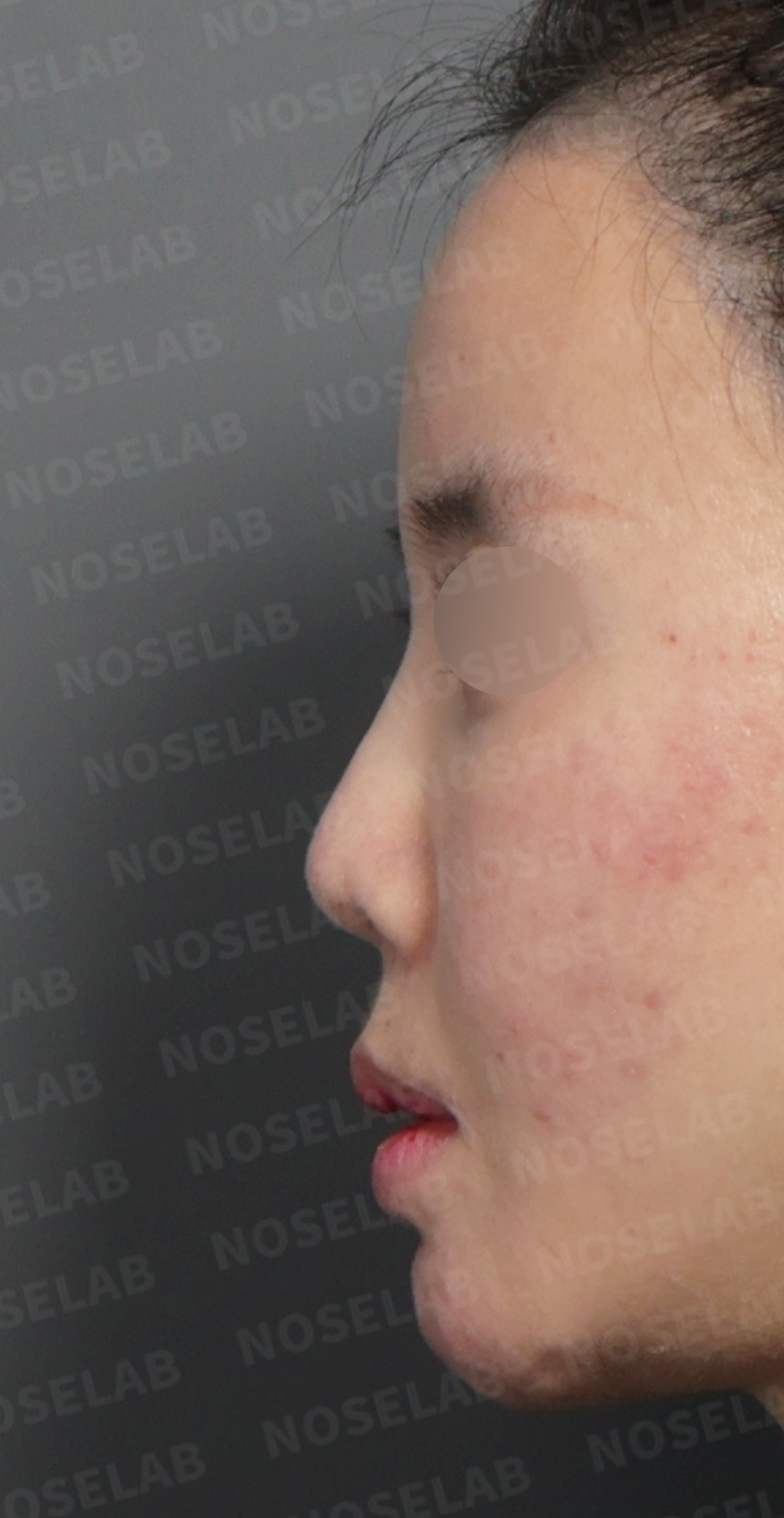 Preoperative consultation: left profile.