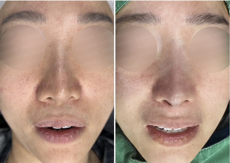 Before and immediately after autologous rib cartilage revision rhinoplasty showing frontal view comparison
