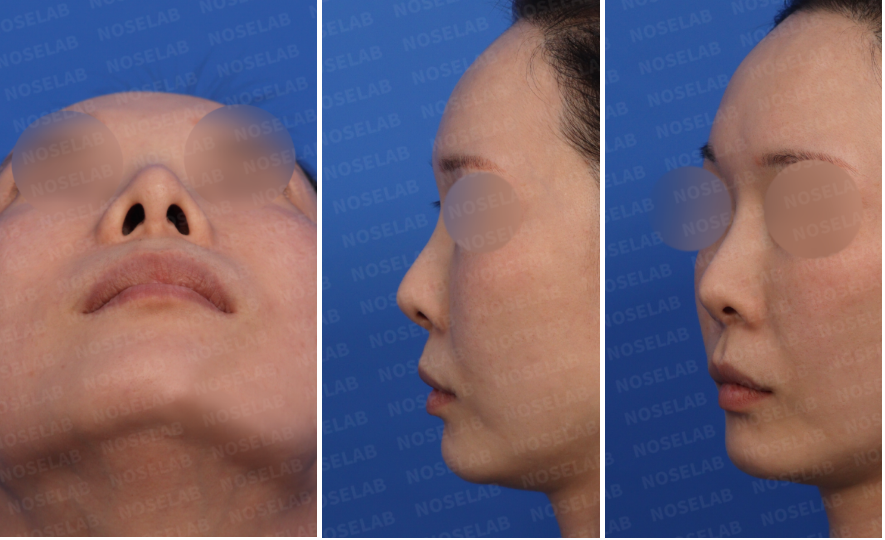 Revision rhinoplasty for short upturned nose – preoperative consultation photos showing nostril, side, and oblique views