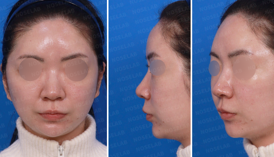 Preoperative views for Bulbous Tip Rhinoplasty Korea showing wide nasal tip and base.
