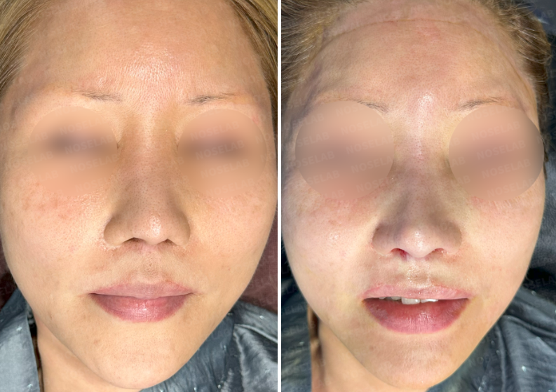Frontal view before surgery (left) after surgery (right)