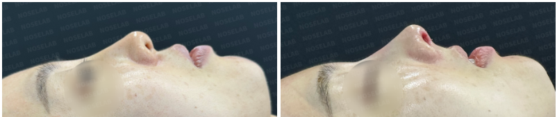Before and after side profile photos showing corrected droopy nose tip, improved nasolabial angle, and smoother nasal bridge.