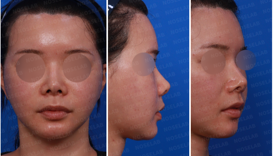 Pre-surgery design consultation – combined frontal, side, and oblique side views before Revision Rhinoplasty Korea with closed approach, showing deviated bridge, upturned nasal tip, and widened nasal structure.