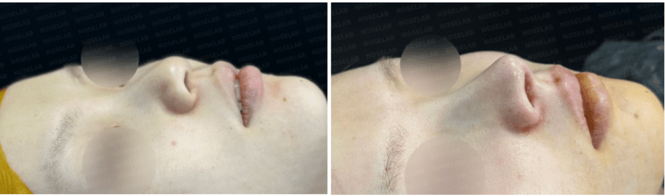 45-degree oblique side view before-and-after photos showing sharper nasal tip, reduced bulbous shape, and improved nasolabial angle