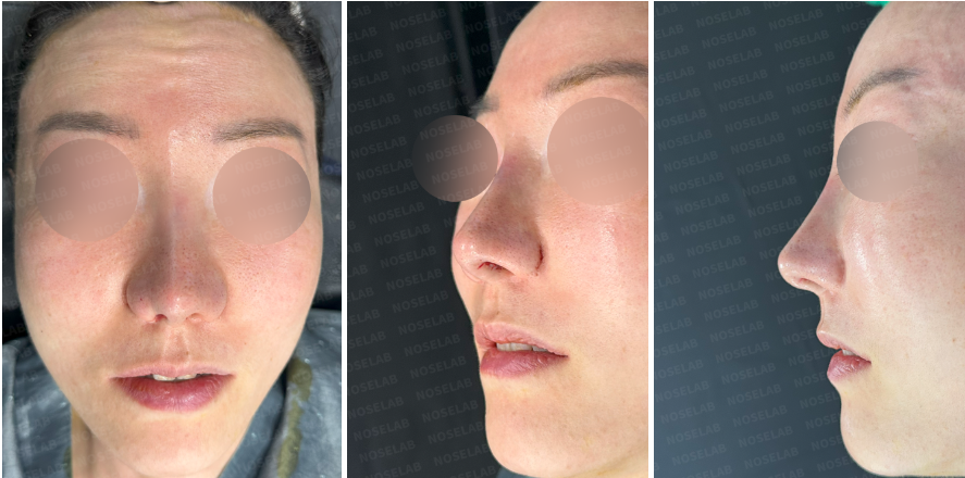 Immediately after surgery: frontal, right side, and oblique side views showing nasal reconstruction results