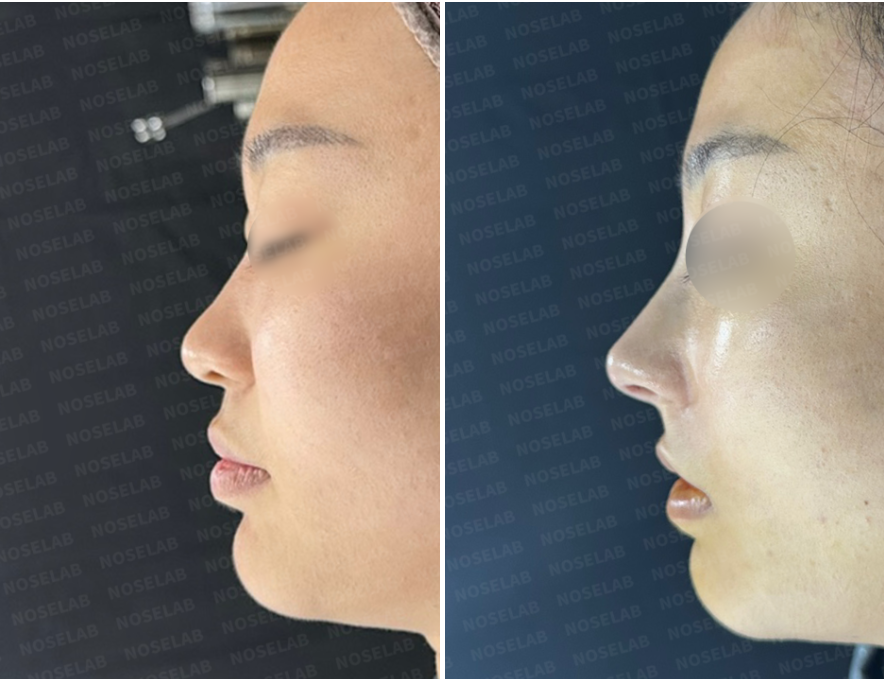 Lateral view comparison showing the patient before surgery (left) and immediately after straight-line rhinoplasty with bulbous tip correction (right).