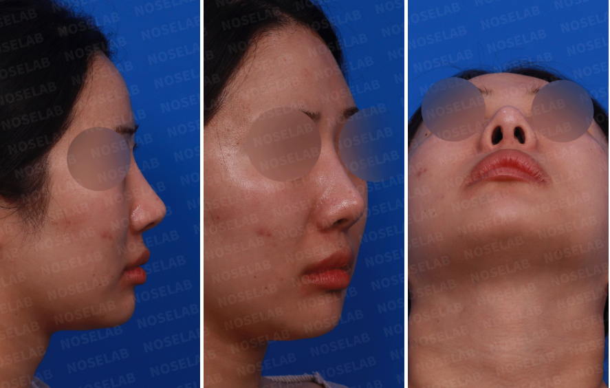 Design consultation photos before customized nasal reconstruction surgery – side view, oblique side view, and nostril view highlighting nasal bridge, tip, and asymmetry