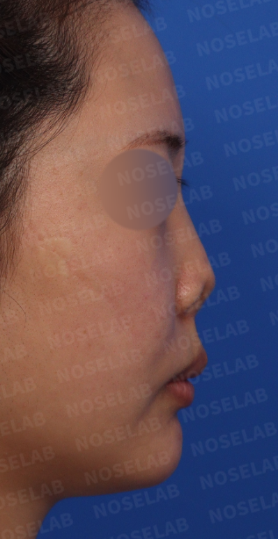 Preoperative side profile showing short and upturned nose before severe nasal contracture correction