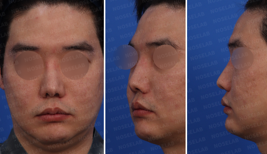 Preoperative design consultation photos for Revision Rhinoplasty for Nasal Asymmetry – frontal view, left oblique side view, and left side view showing nostril imbalance and deviation.