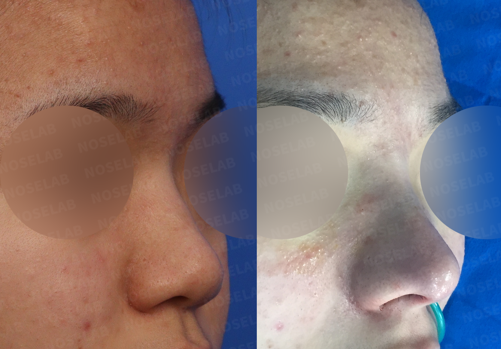Three-quarter angle comparison showing natural contour improvement following nasal reshaping surgery