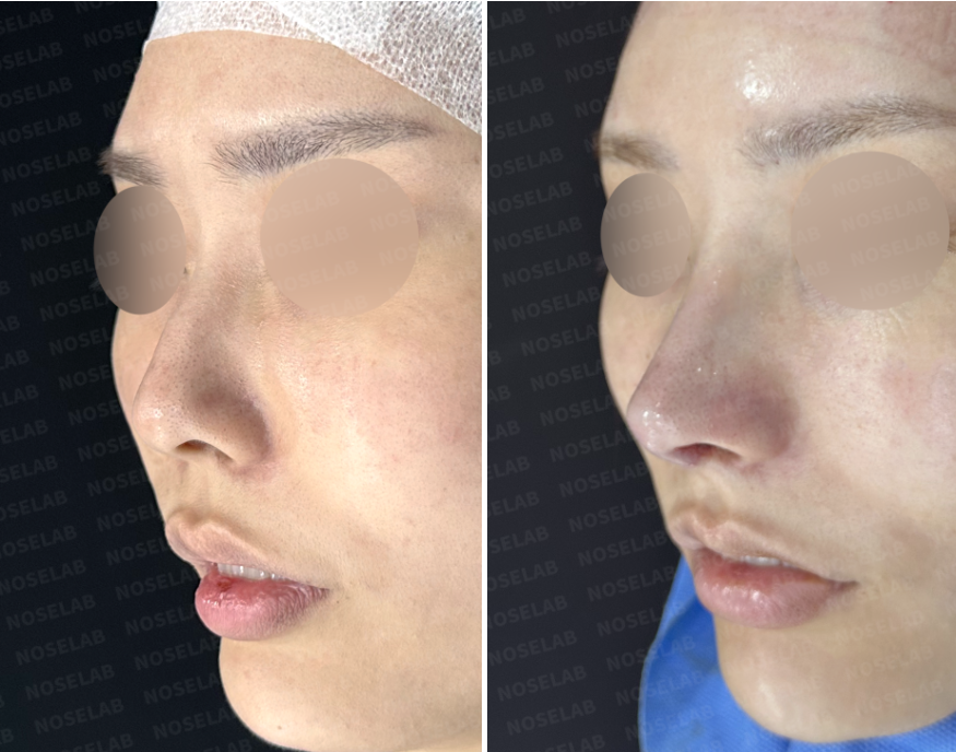 Oblique view before and immediately after autologous rib cartilage rhinoplasty