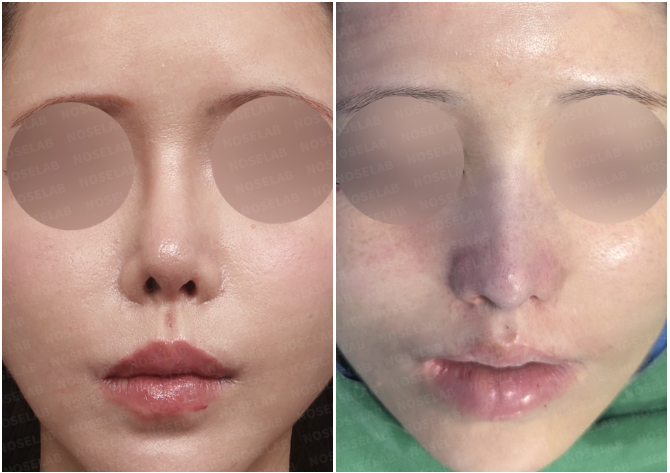 Frontal before and immediately after views showing upturned nasal tip correction rhinoplasty with reduced nostril exposure.
