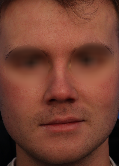 Preoperative frontal view design consultation showing short and blunt nose before no-implant rhinoplasty