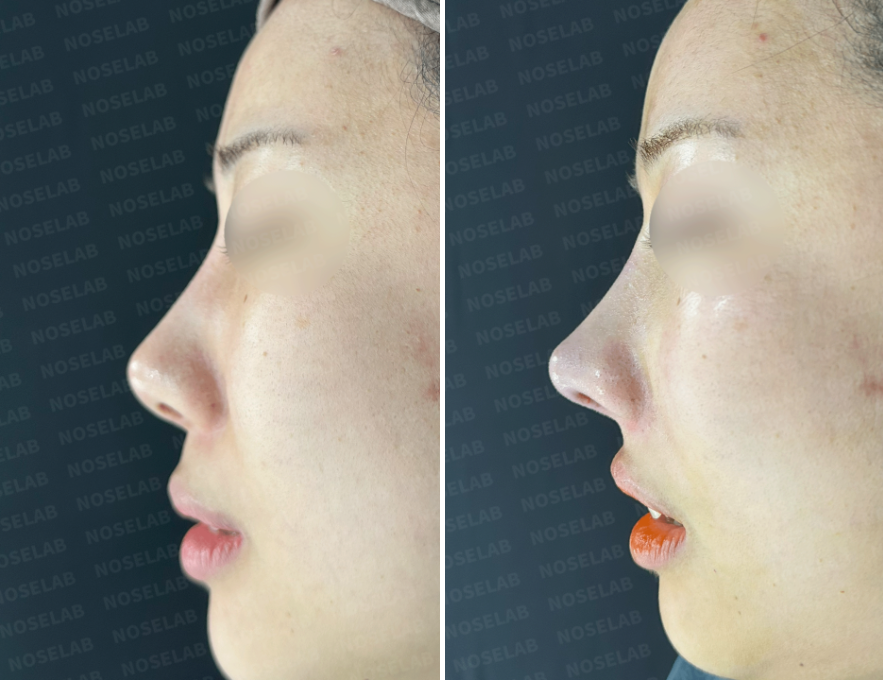 Side view before and immediately after customized nasal reconstruction surgery – lowered nasal starting point, refined tip, and natural straight dorsum.