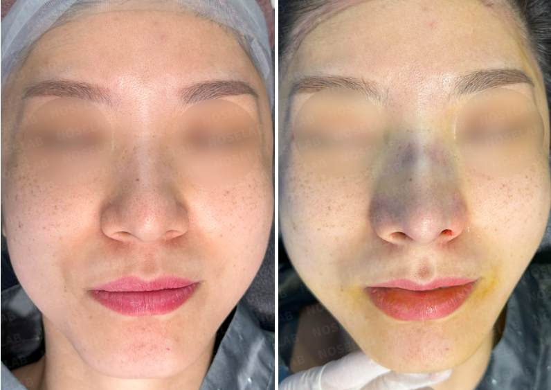 Frontal view before surgery (left), After surgery (right)