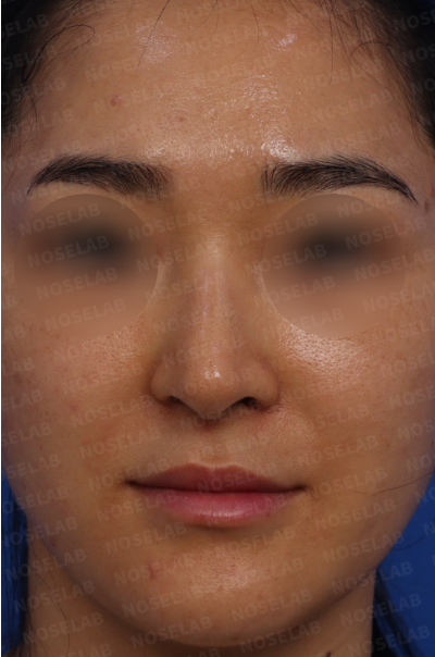 Nose hump correction Korea – preoperative frontal view of long and deviated nose with nostril asymmetry