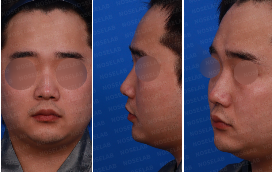 Male Rhinoplasty Korea – Pre-surgery analysis of a 29-year-old male patient with a short, wide nose. Photos show frontal, side, and oblique views before closed rhinoplasty to plan nasal tip refinement, bridge augmentation, and nostril correction.