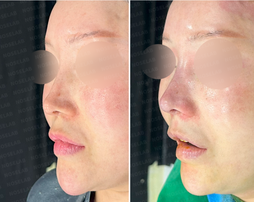 Oblique right side view before and after contracted nose reconstruction using autologous rib cartilage, showing enhanced nasal projection and natural soft contour.