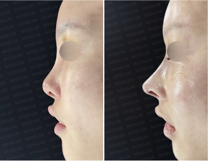Before and immediately after surgery lateral view showing lowering of the high radix and formation of a smooth, natural dorsal line following revision closed rhinoplasty with rib cartilage reconstruction.