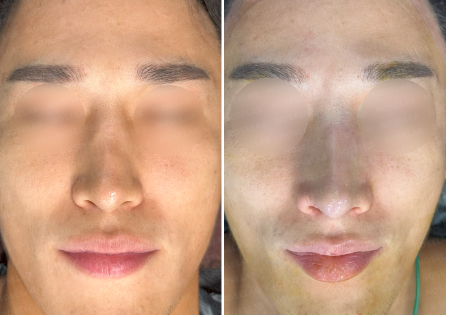 Before (left) and immediately after surgery (right) frontal view photos of a male patient, showing correction of crooked nose and improved nasal symmetry.