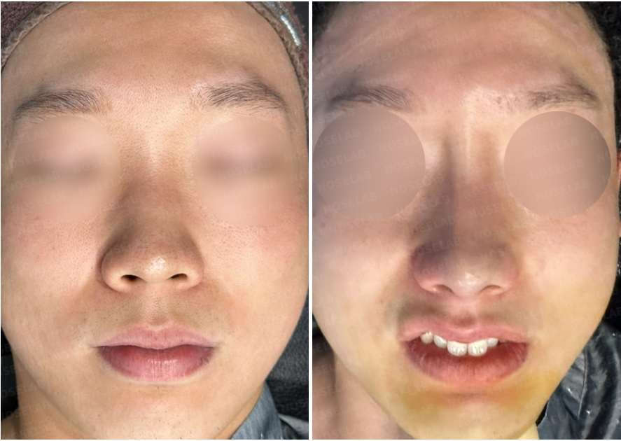 Frontal before-and-after photos of rhinoplasty for upturned nose, small nose, and nasolabial angle correction.