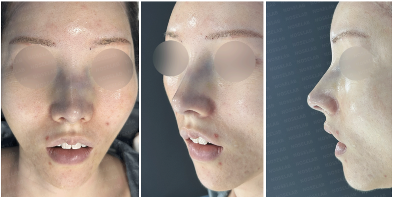 Immediately after surgery photos showing the patient’s frontal, oblique, and side views, highlighting the improved nasal tip projection and natural midface contour at NoseLab Clinic.