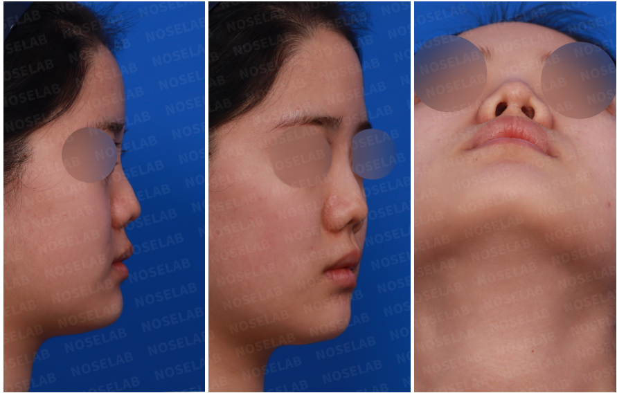 Correcting Nostril Stenosis – Design consultation showing right side, oblique side, and nostril view photos before revision rhinoplasty.