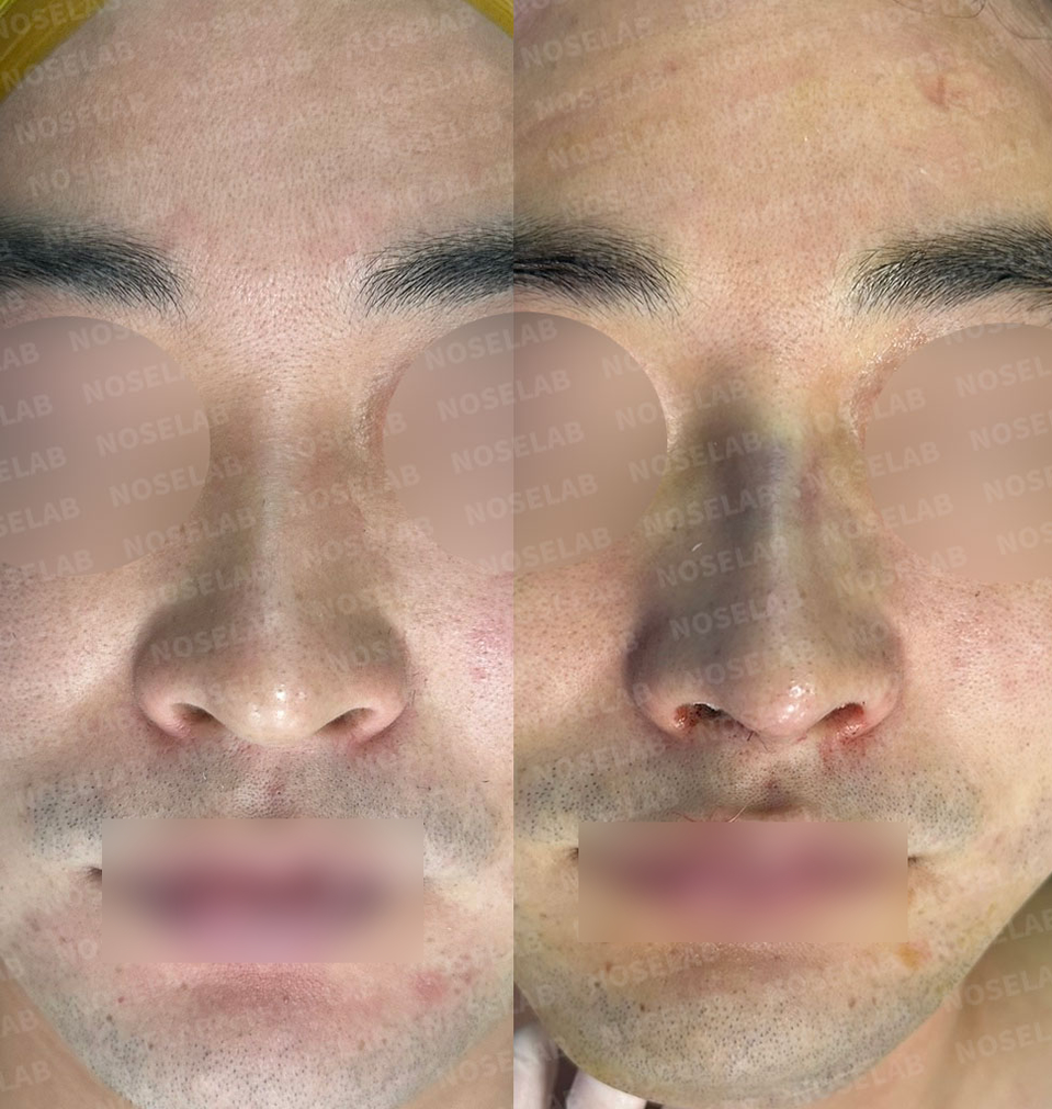 “Before and after frontal view photos of deviated nose correction and hump removal through closed rhinoplasty. The nose tip and bridge show improved symmetry and balanced proportions. (Noselab Clinic)”