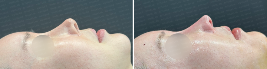 Before and immediately after revision rhinoplasty: lateral side view comparison showing nasal bridge correction and tip refinement