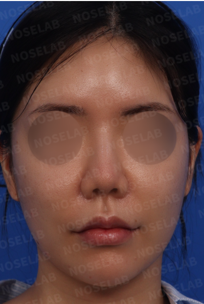 Preoperative frontal view before bulbous nose and retracted columella correction with closed rhinoplasty in Korea