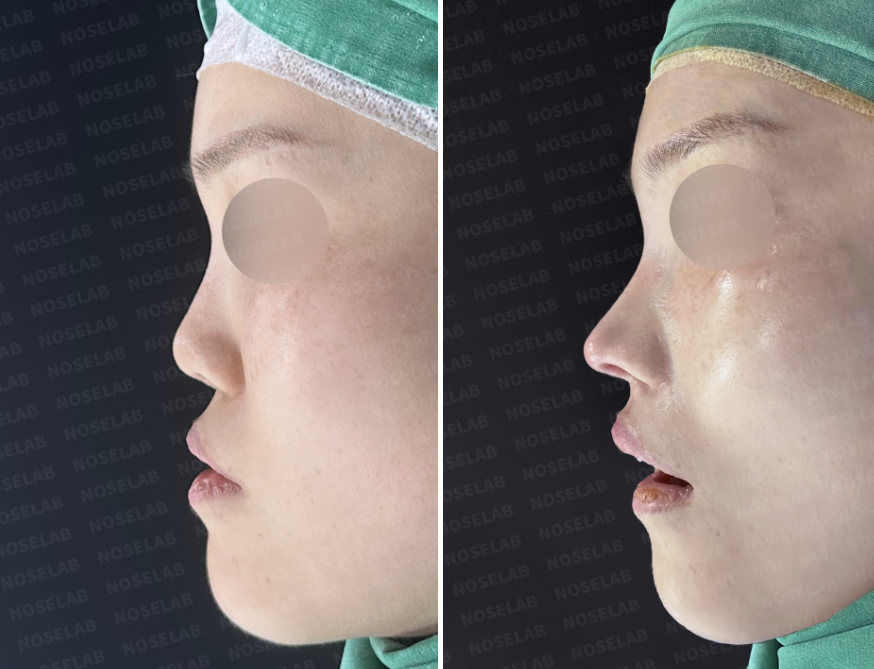 Before and immediately after short nose correction, lateral view showing improved nasal length, lowered tip, and refined facial balance.