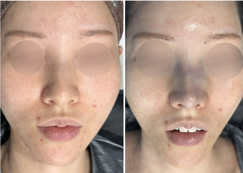 Frontal view of a female patient before surgery (left) and immediately after surgery (right) at NoseLab Clinic, showing nasal and facial structure changes.