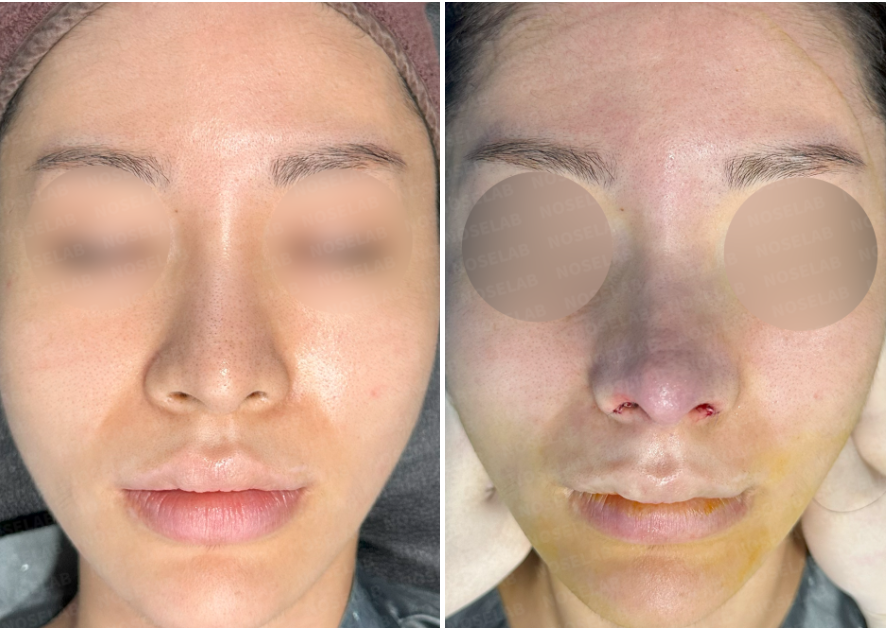 Frontal view comparison of rhinoplasty before surgery (left) and after surgery (right), showing improvement in bulbous and drooping nasal tip