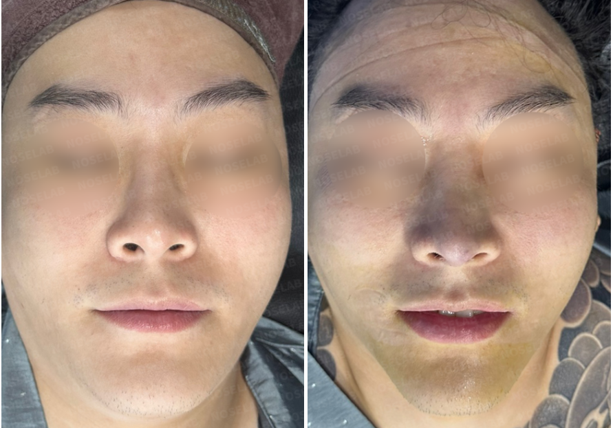 Frontal view before and after male rhinoplasty Korea: correction of curved nose and excessive nostril exposure