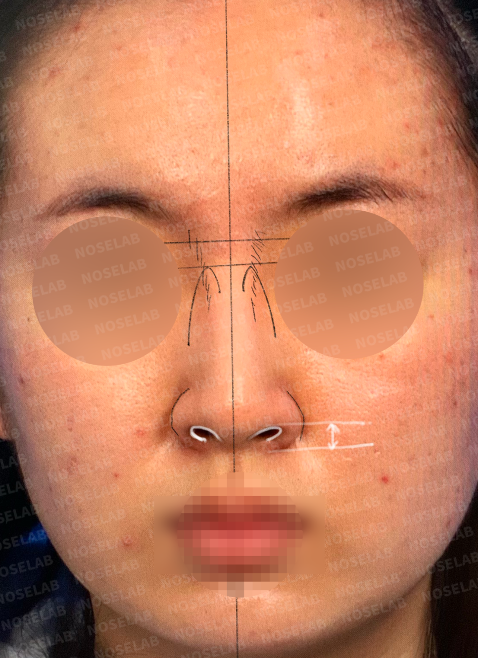 Frontal view analysis showing nasal width and deviation assessment for closed rhinoplasty planning