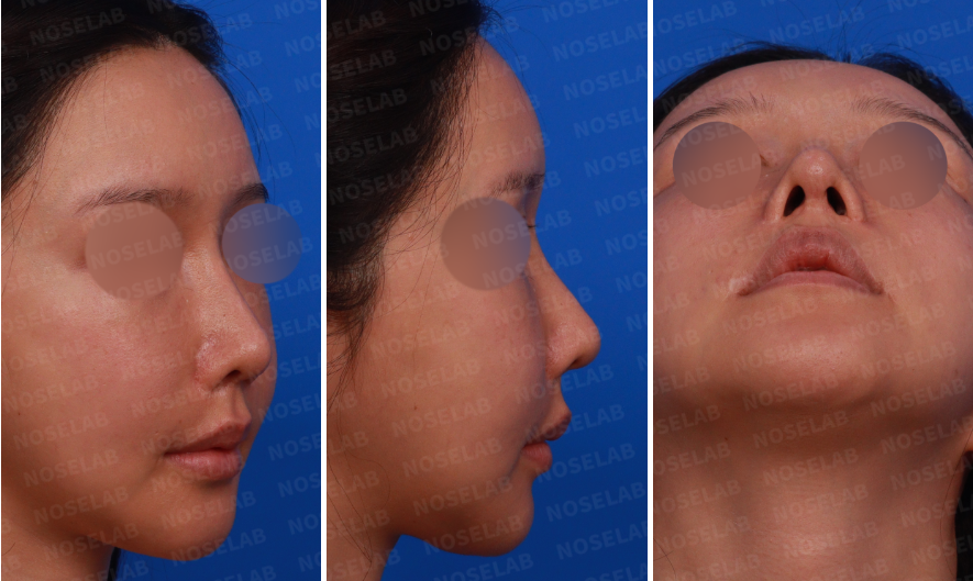 Rhinoplasty for long mid-face correction – preoperative consultation photos showing right oblique, right side, and nostril views