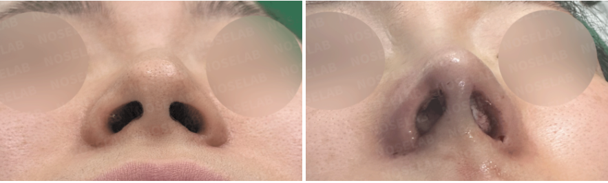Nostril view before (left) and immediately after (right) hump nose and deviated nose correction, showing restored symmetry and natural contour – Nose Lab Clinic