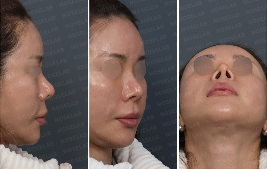 Preoperative design consultation photos showing over-rotated nasal tip, pinched alae, and nostril overexposure from right lateral, right oblique, and basal views.