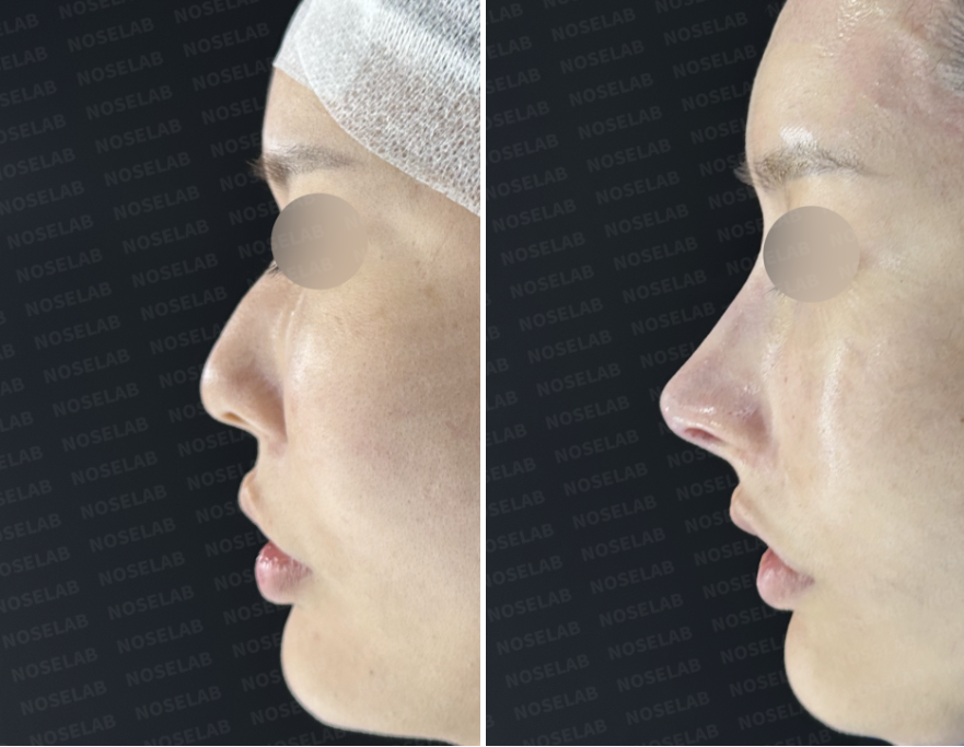 Side profile before and immediately after autologous rib cartilage rhinoplasty