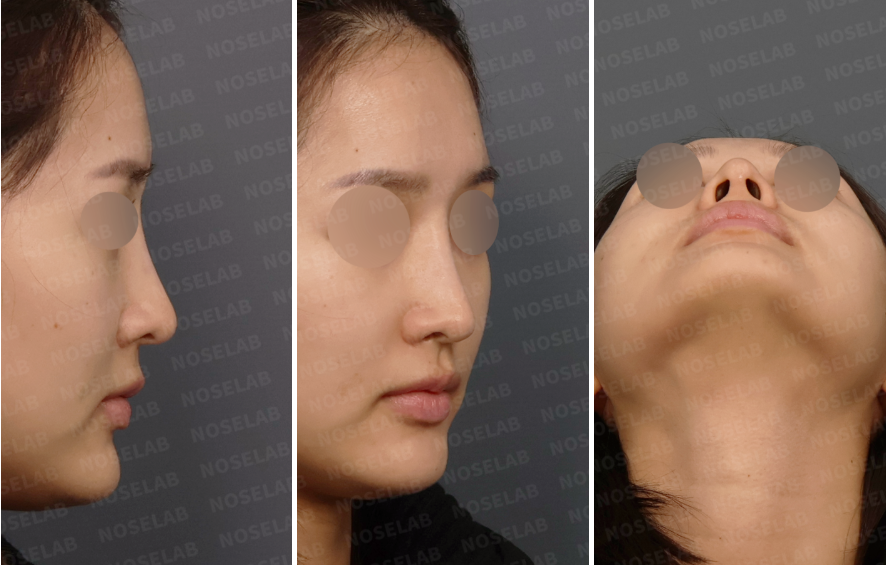 Preoperative design consultation photos showing right side view, right oblique side view, and nostril view of a female revision rhinoplasty patient with a long-looking nose and drooping nasal tip.