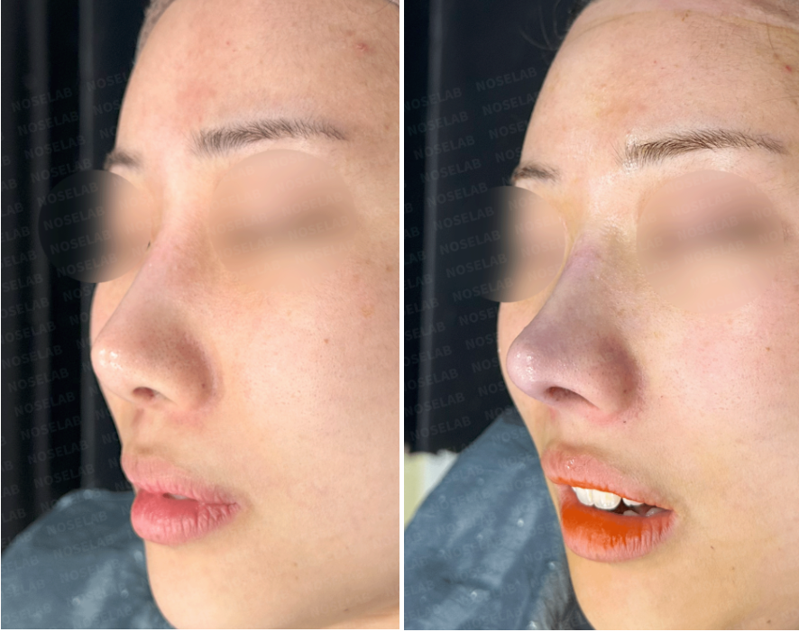 Oblique side view before and immediately after customized nasal reconstruction – refined nasal tip, lowered bridge starting point, and improved facial harmony.