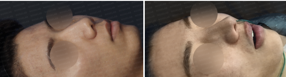 45-degree angle view before and after Closed Rhinoplasty Korea, showing improved nasal bridge contour and balanced nose tip projection.