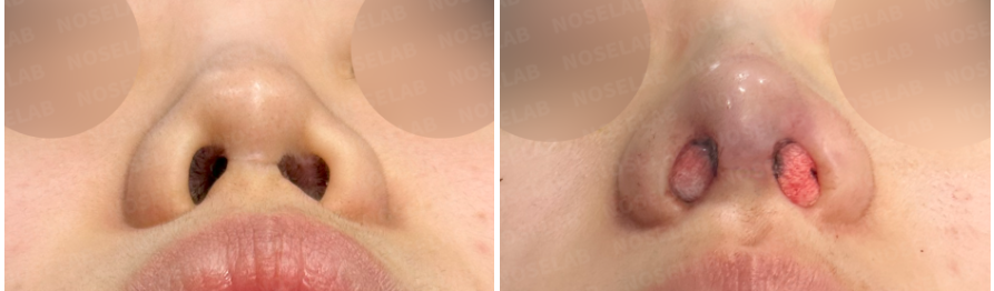 Correcting Nostril Stenosis – Before (left) and immediately after (right) revision rhinoplasty, nostril view showing widened and symmetrical nasal openings.