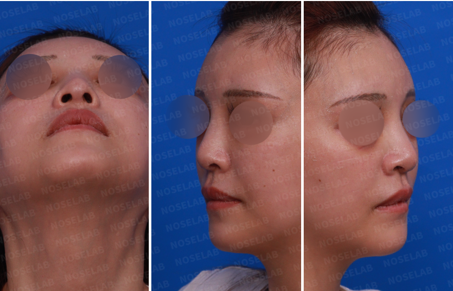 Pre-surgery design consultation photos for mesh removal rhinoplasty: frontal view and both side views showing bulbous nasal tip and asymmetry.